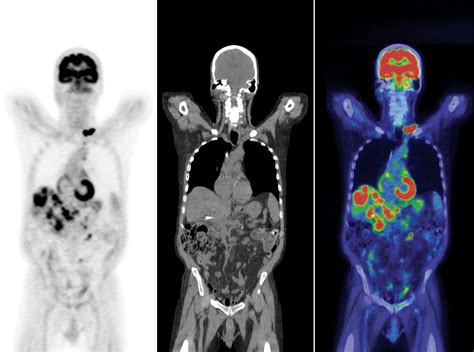 Will a PET Scan Show Breast Cancer? And Can It Predict the Future of Your Morning Coffee?